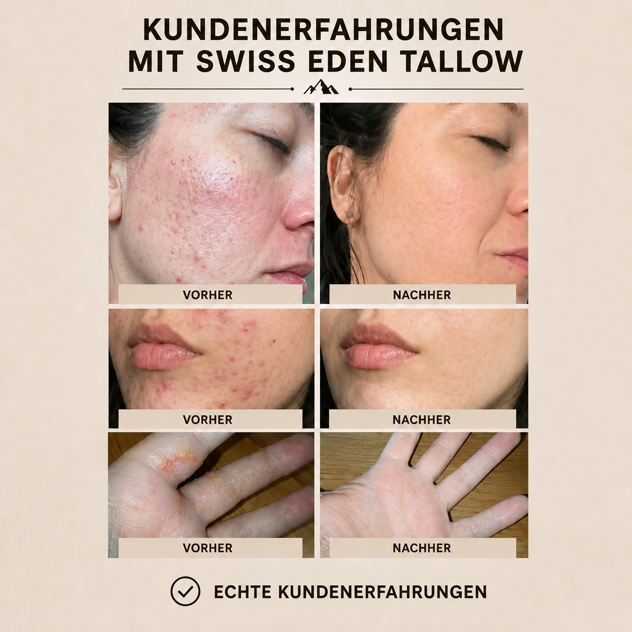 Echte Kundenerfahrungen mit Swiss Eden Tallow Orange und Jojoba – Vorher Nachher Bilder bei unreiner Haut